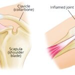 सर्दियों में क्यों बढ़ जाती है फ्रोजन शोल्डर की समस्या  जानिए लक्षण, कारण, जोखिम और बचाव विशेष बातचीत: डॉ. ए.के. वर्मा