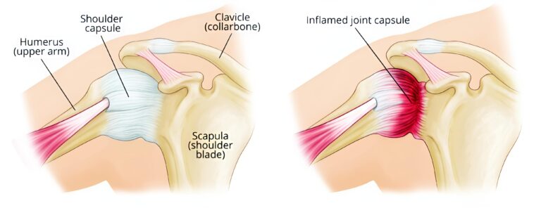 सर्दियों में क्यों बढ़ जाती है फ्रोजन शोल्डर की समस्या  जानिए लक्षण, कारण, जोखिम और बचाव विशेष बातचीत: डॉ. ए.के. वर्मा